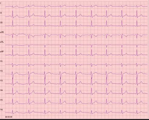 窦性心律的心电图特点:(1)p波规律出现,在Ⅰ,Ⅱ导联直立,在avr导联中